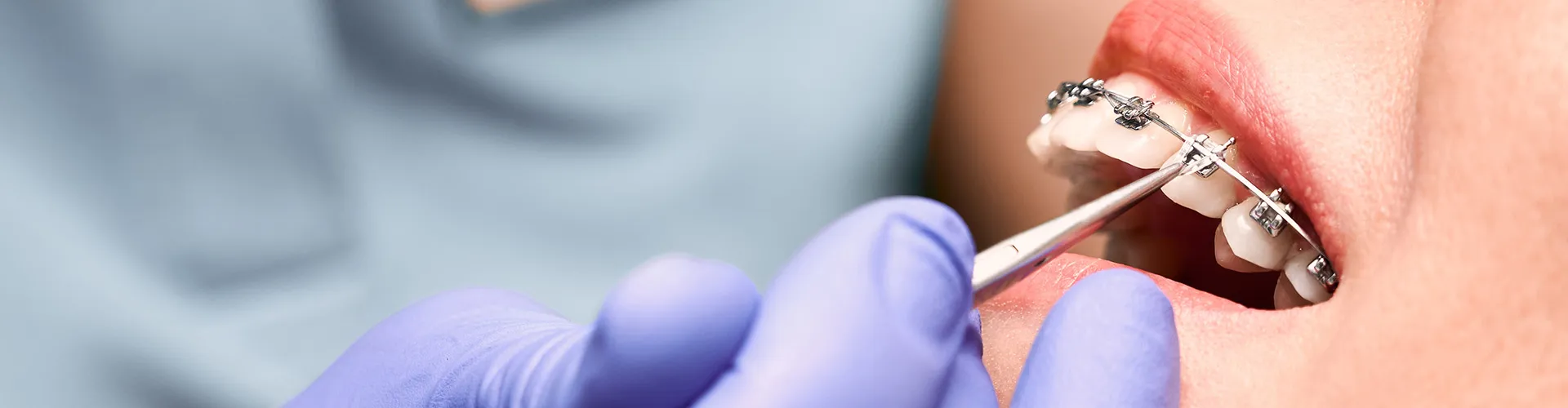 gloved handing applying rubberband to braces with dental tool