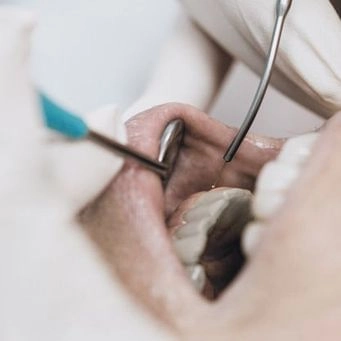 Close-up of dentist performing laser dentistry procedure.