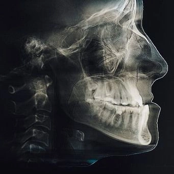 Profile view of a human skull and jaw, showing teeth and cervical spine in a dental X-ray.